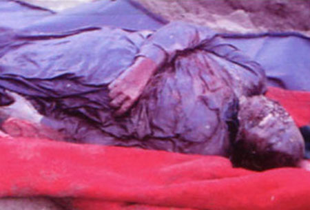 Gaza white Gaza white phosphorous victim 1