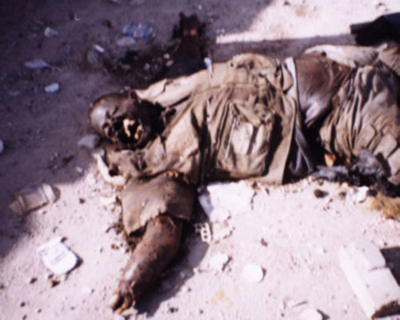 Gaza white phosphorous victim 3